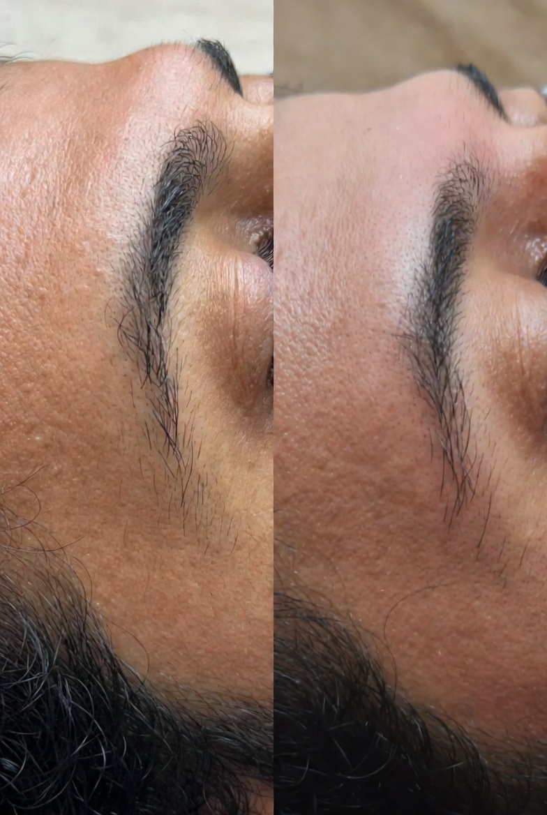 Hair Removal - Male - Before