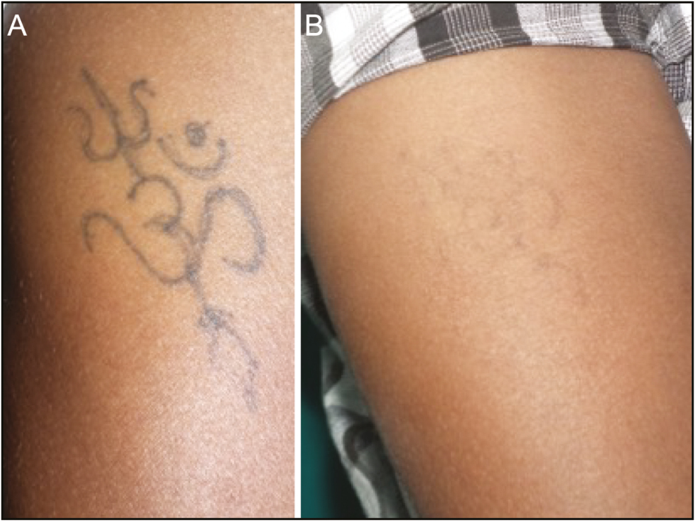Tattoo Removal - Before